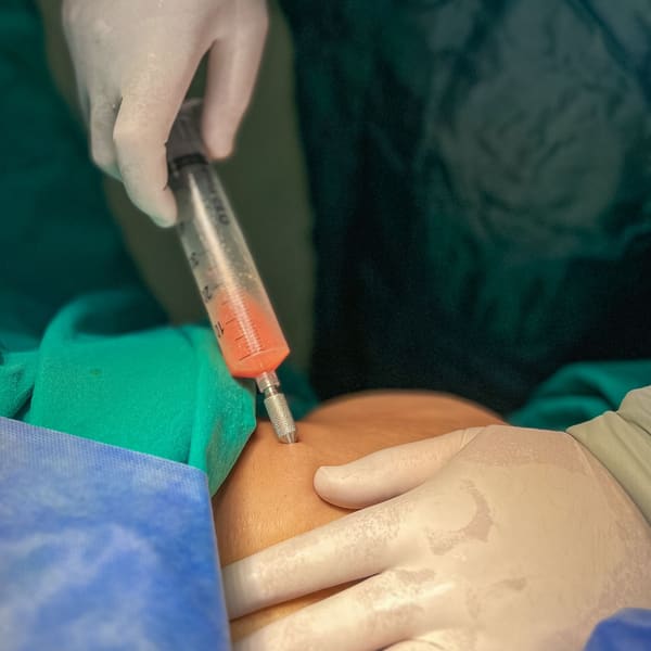 A gloved pain specialist performs an injection procedure through a sterile drape, guiding the needle by hand.